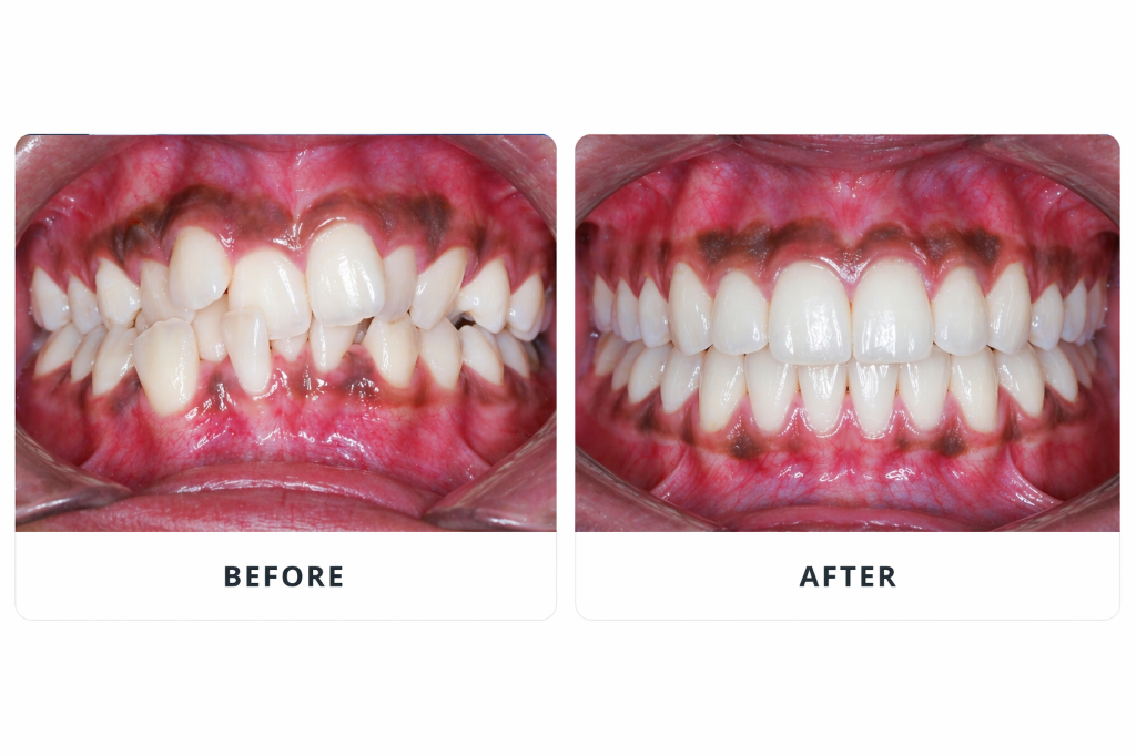 Clear Aligners Before & After — Sahara Dental Care, Doddaballapur