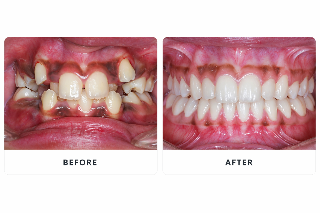 Braces Before & After — Sahara Dental Care, Doddaballapur