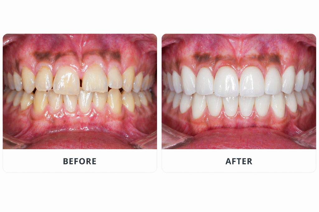 Cosmetic Dentistry Before & After — Sahara Dental Care, Doddaballapur